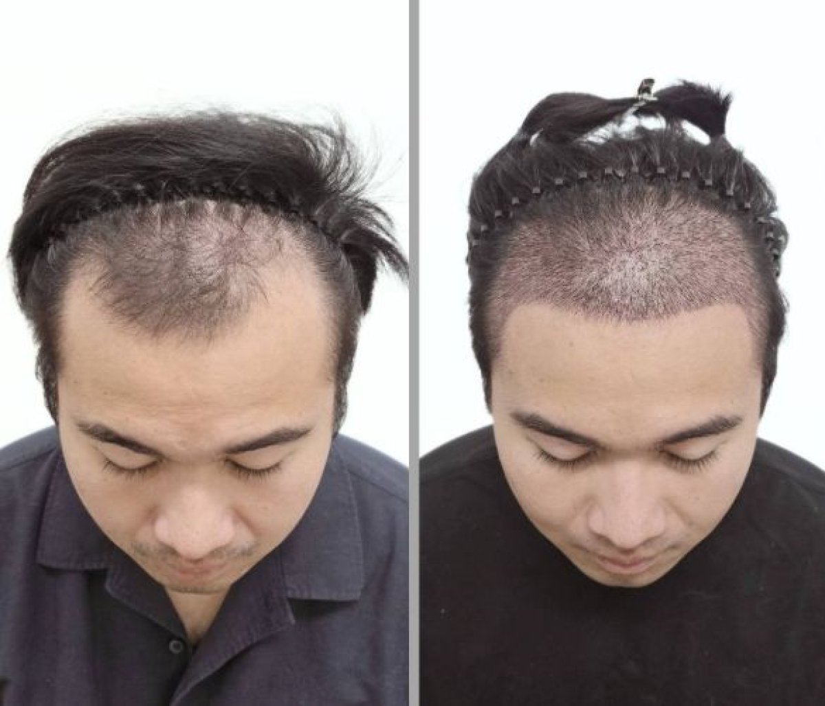 Vorher-nachher-Ergebnis Haartransplantation bei Dr.Nutt Clinic, verbesserte Haardichte Männer