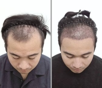 Resultados de trasplante capilar antes y después en Dr.Nutt Clinic, mayor densidad capilar masculina