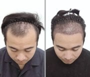 Resultados de trasplante capilar antes y después en Dr.Nutt Clinic, mayor densidad capilar masculina