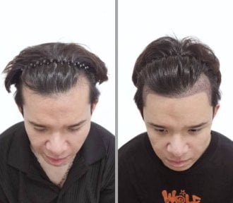 Resultados de trasplante capilar antes y después en Dr.Nutt Clinic, restauración de la línea