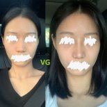 Результаты ринопластики до и после в VG Plastic Surgery, естественная форма носа
