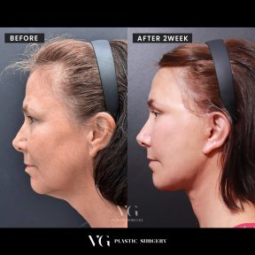 Vorher-nachher-Ergebnis Deep Plane Facelift bei VG Plastic Surgery, sichtbare Verjüngung