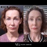 Vorher-nachher-Ergebnis Deep Plane Facelift bei VG Plastic Surgery, sichtbare Verjüngung