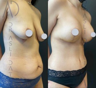 Vorher-nachher-Ergebnis Bruststraffung bei Liv Hospital Ulus, verbesserte Form und Kontur