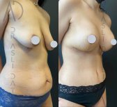 Vorher-nachher-Ergebnis Bruststraffung bei Liv Hospital Ulus, verbesserte Form und Kontur