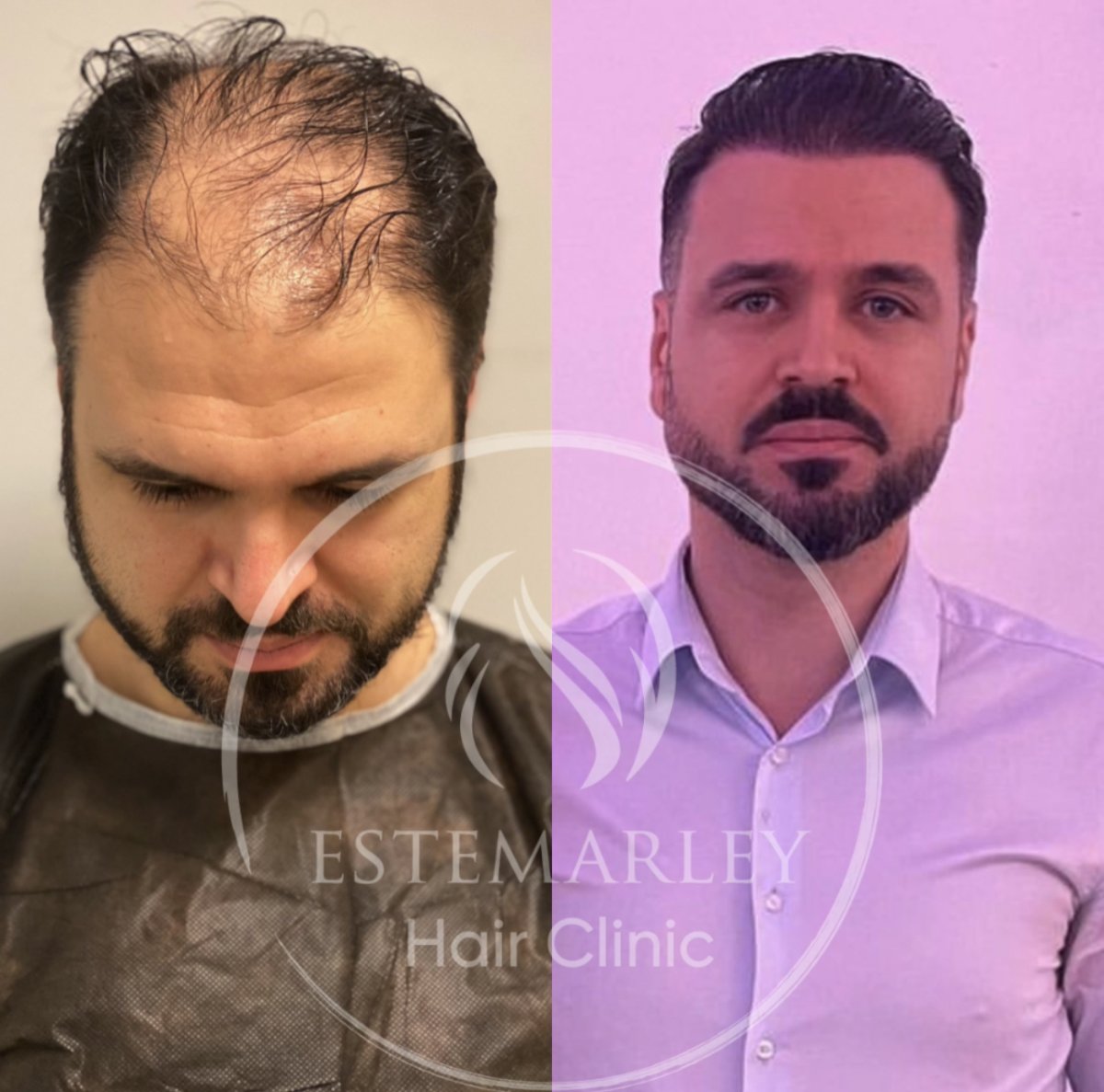 Vorher-nachher-Ergebnis Haartransplantation bei Estemarley – volle Haarlinie wiederhergestellt