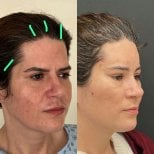 Facelift before and after results at Dr. Safa Manav Clinic, visible facial rejuvenation