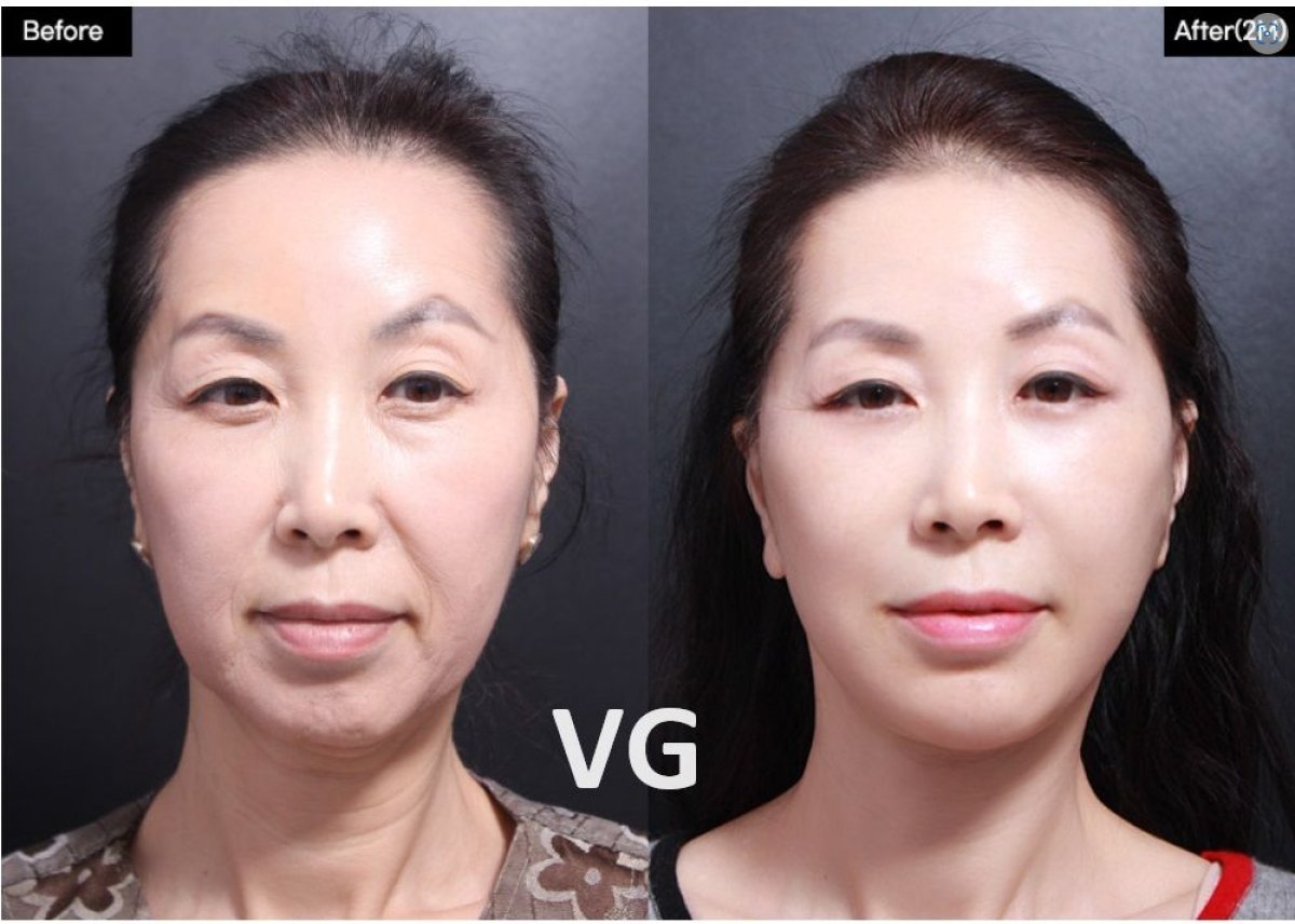 Resultados de lifting endoscópico facial antes y después en VG Plastic Surgery, rejuvenecimiento