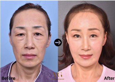 Vorher-nachher-Ergebnis der Blepharoplastik bei VG Plastic Surgery, Lidkorrektur