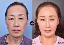 Vorher-nachher-Ergebnis der Blepharoplastik bei VG Plastic Surgery, Lidkorrektur