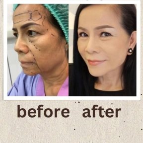Deep plane facelift before and after results at ID Clinic Bangkok, facial rejuvenation outcome