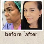 Deep plane facelift before and after results at ID Clinic Bangkok, facial rejuvenation outcome