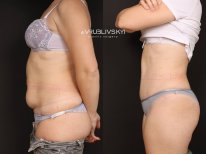 Before and after liposuction results at Dr. VRUBLIVSKYI Plastic Surgery, abdomen contouring