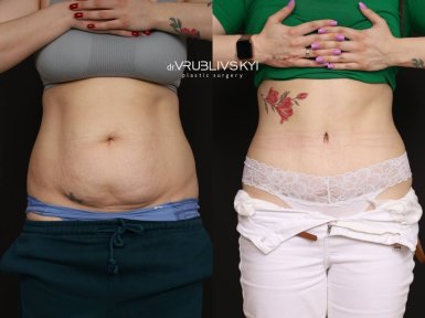 Before and after liposuction results at Dr. VRUBLIVSKYI Plastic Surgery, slimmer abdomen contour