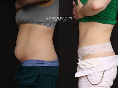 Before and after liposuction results at Dr. VRUBLIVSKYI Plastic Surgery, slimmer abdomen contour
