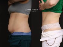 Before and after liposuction results at Dr. VRUBLIVSKYI Plastic Surgery, slimmer abdomen contour