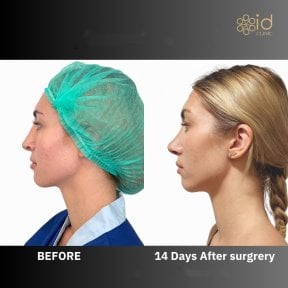 Revision rhinoplasty before and after results at ID Clinic Bangkok, improved nose profile