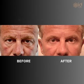 Before and after blepharoplasty results at ID Clinic Bangkok, eyelid correction for men