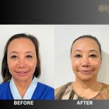 Before and after deep plane facelift results at ID Clinic Bangkok, facial rejuvenation outcome