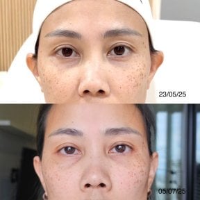 До и после терапии стволовыми клетками в EDNA Wellness – омоложение кожи лица