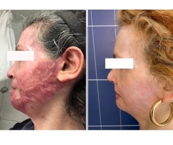 Before and after stem cell rejuvenation therapy results at LaCLINIQUE of Switzerland, face scars