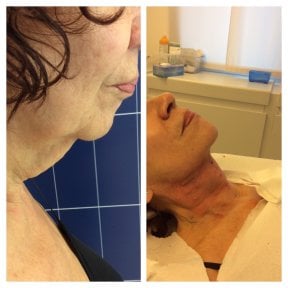 Before and after stem cell rejuvenation therapy at LaCLINIQUE of Switzerland, neck tightening result