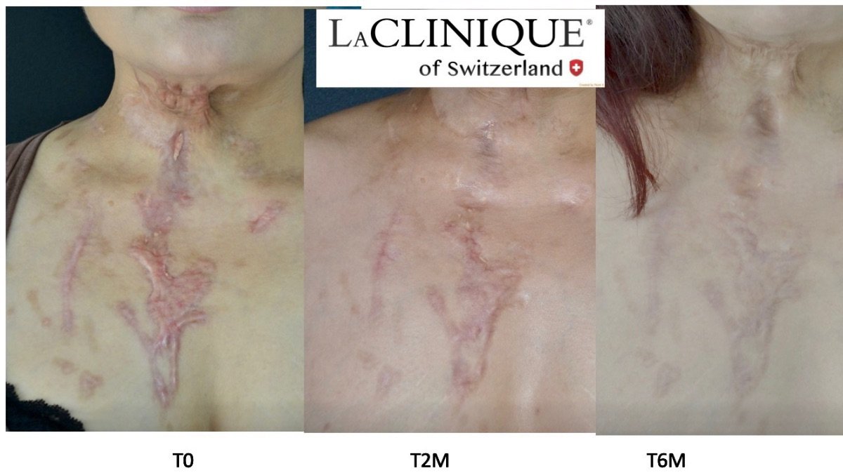 Résultats de réduction des cicatrices après thérapie cellulaire à LaCLINIQUE of Switzerland