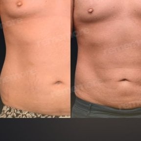 Before and after liposuction results at Memorial Bahçelievler Hospital, improved abdomen contour