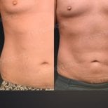Before and after liposuction results at Memorial Bahçelievler Hospital, improved abdomen contour