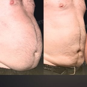 Before and after liposuction results at Memorial Bahçelievler Hospital, abdomen contouring