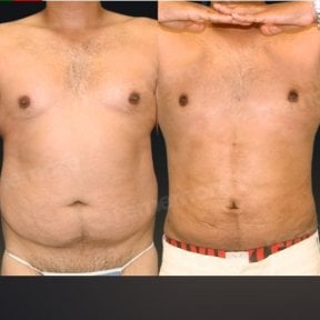 Before and after liposuction results at Memorial Bahçelievler Hospital, improved abdomen contour