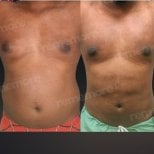 Before and after liposuction results at Memorial Bahçelievler Hospital, improved body contour