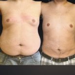 Before and after liposuction results at Memorial Bahçelievler Hospital, improved body contour