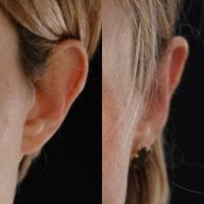 نتائج تجميل الأذن قبل وبعد في Yurchenko Plastic Surgery Team Kyiv، إعادة تشكيل الأذن