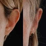 نتائج تجميل الأذن قبل وبعد في Yurchenko Plastic Surgery Team Kyiv، إعادة تشكيل الأذن