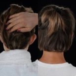 نتائج عملية تجميل الأذن قبل وبعد في Yurchenko Plastic Surgery Team Kyiv