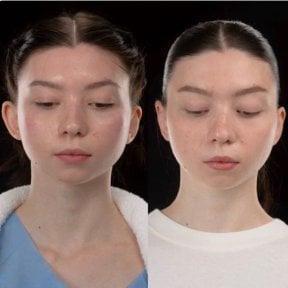 نتائج تجميل الأذن قبل وبعد في Yurchenko Plastic Surgery Team Kyiv، إعادة تشكيل الأذن