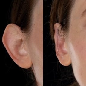نتائج عملية تجميل الأذن قبل وبعد في Yurchenko Plastic Surgery Team Kyiv، تصحيح الأذن