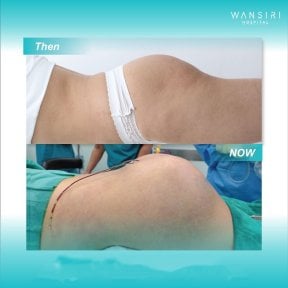 Before and after Brazilian Butt Lift results at Wansiri Hospital, enhanced buttock contour