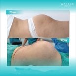 Before and after Brazilian Butt Lift results at Wansiri Hospital, enhanced buttock contour