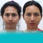 Результаты феминизирующей пластики лица до и после в Wansiri Hospital, утончённые черты