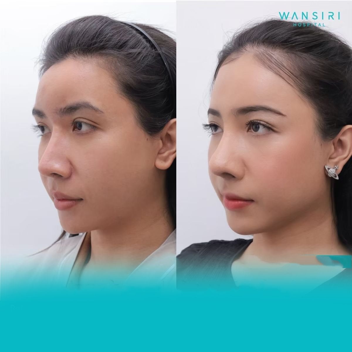 Resultados de cirugía de feminización facial antes y después en Wansiri Hospital, rasgos refinados
