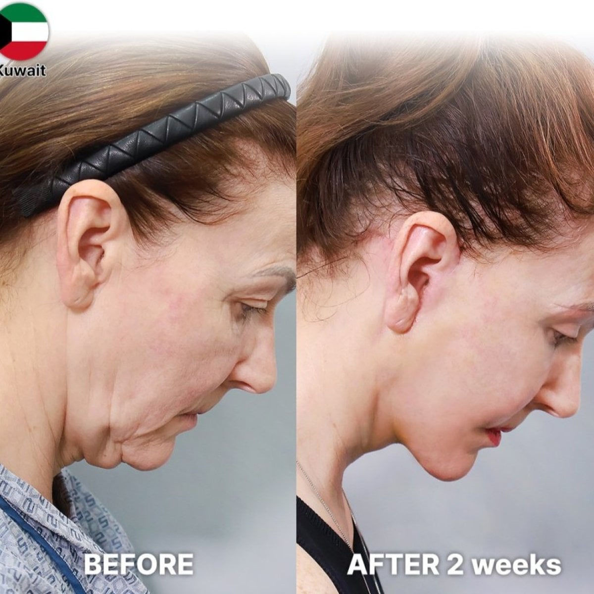 Resultados de lifting facial antes y después en Returning Plastic Surgery – rejuvenecimiento facial