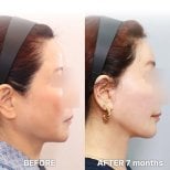 Resultados de lifting facial antes y después en Returning Plastic Surgery, mejora del contorno
