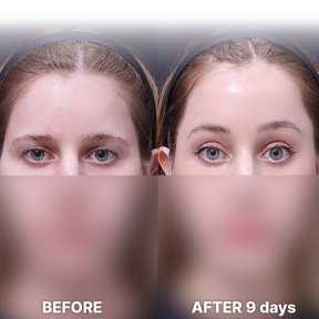 Stirnlifting Vorher-nachher-Ergebnis bei Returning Plastic Surgery, sichtbare Brauenanhebung