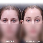 Stirnlifting Vorher-nachher-Ergebnis bei Returning Plastic Surgery, sichtbare Brauenanhebung