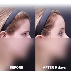 Stirnlift Vorher-nachher-Ergebnis nach 9 Tagen bei Returning Plastic Surgery, sichtbare Anhebung