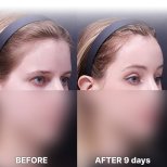 Stirnlift Vorher-Nachher-Ergebnis bei Returning Plastic Surgery, sichtbare Brauenanhebung