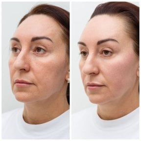 Resultados de lifting facial antes y después en Altos Clinic – rejuvenecimiento visible