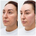 Resultados de lifting facial antes y después en Altos Clinic – rejuvenecimiento visible